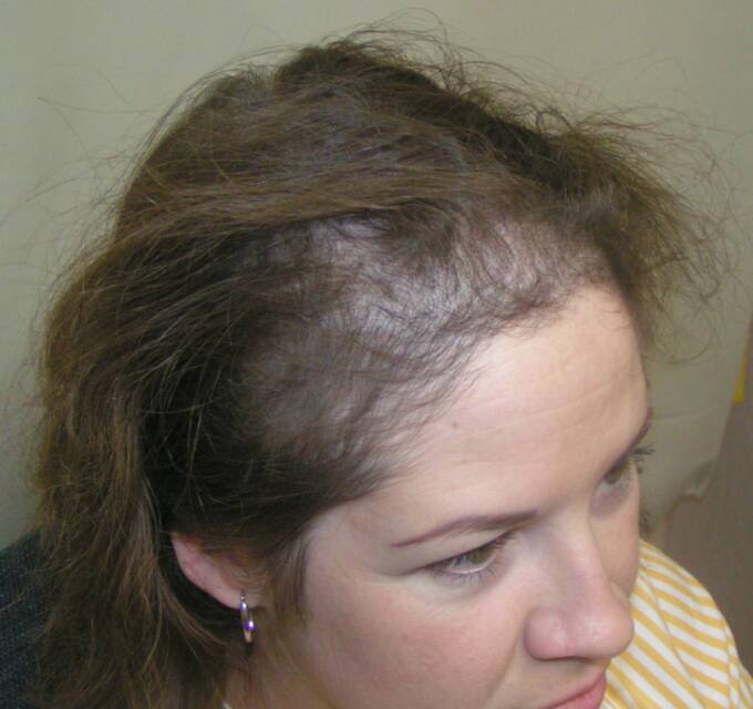 Female Hair Loss Photo 1